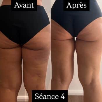 harmonie-chalons-adipologie-avant-apres-jambes