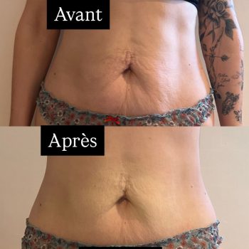 harmonie-chalons-adipologie-avant-apres-ventre-1