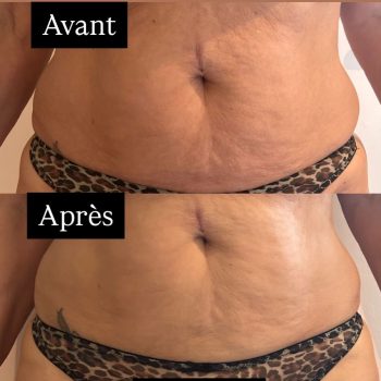 harmonie-chalons-adipologie-avant-apres-ventre-3
