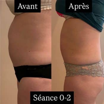 harmonie-chalons-adipologie-avant-apres-ventre