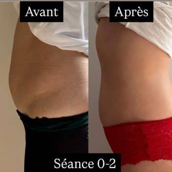 harmonie-chalons-adipologie-avant-apres-ventre2